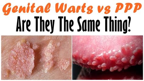 penile papules vs warts